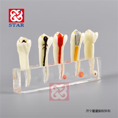 牙髓病治疗模型M4007
